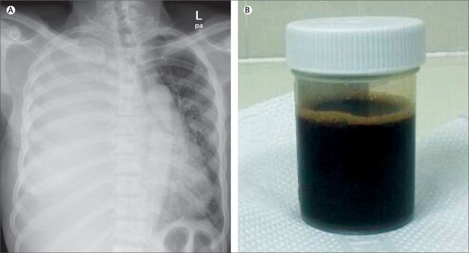 Black Pleural Effusion