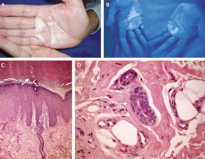 Aquagenic Keratoderma