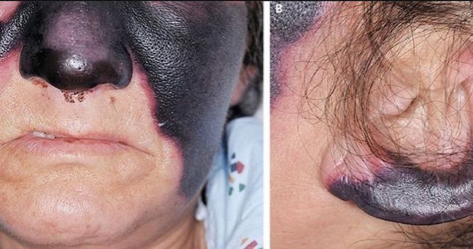 Skin discolouration in cocaine abuse patient