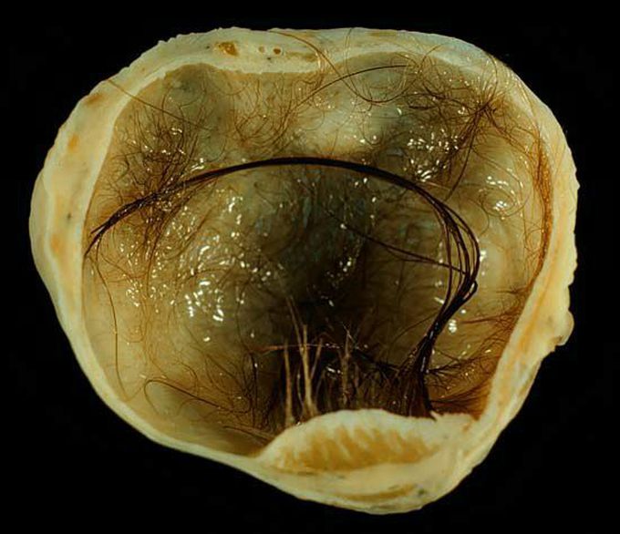 A small (4 cm) dermoid cyst of an ovary.