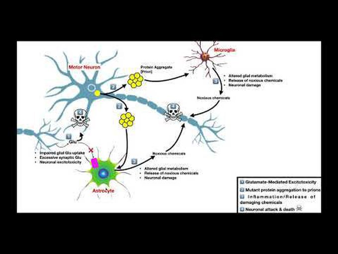Amyotrophic Lateral Sclerosis (ALS): Overview