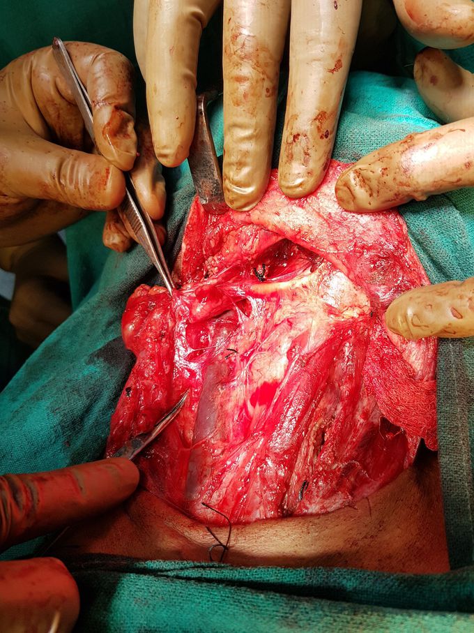 Completion thyroidectomy +MRND 2