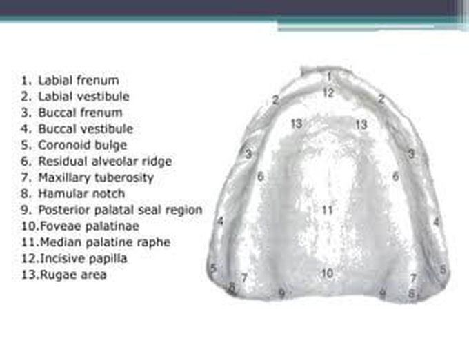 Coronoid bulge