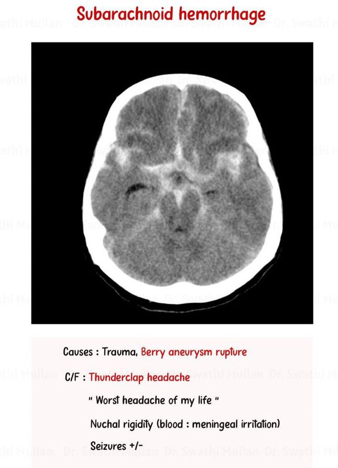 Subarachnoid Hematoma