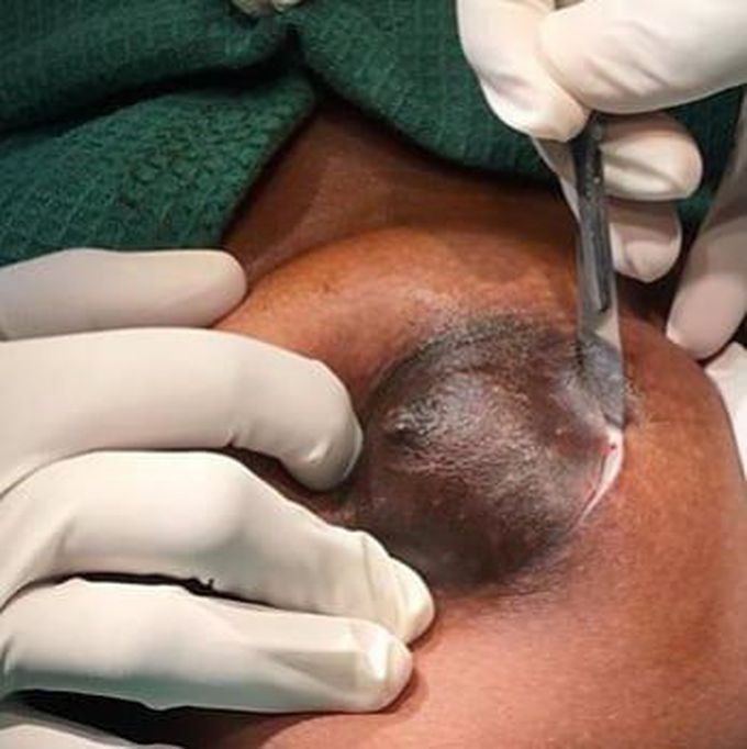 Gaint fibroadenoma breast cancer