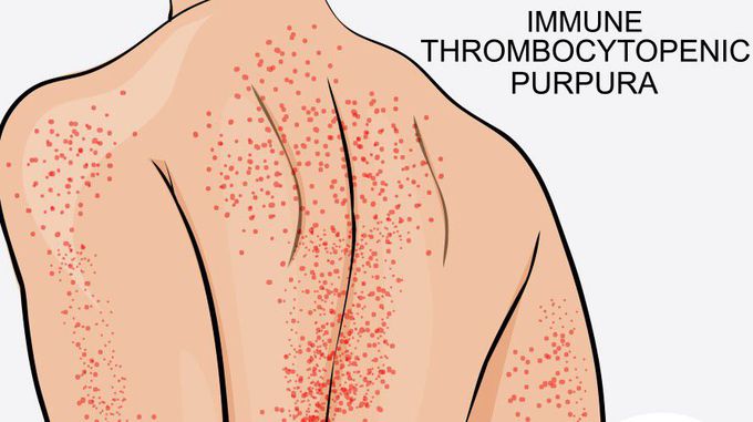 Symptoms of ldiopathic thrombocytopenic purpura