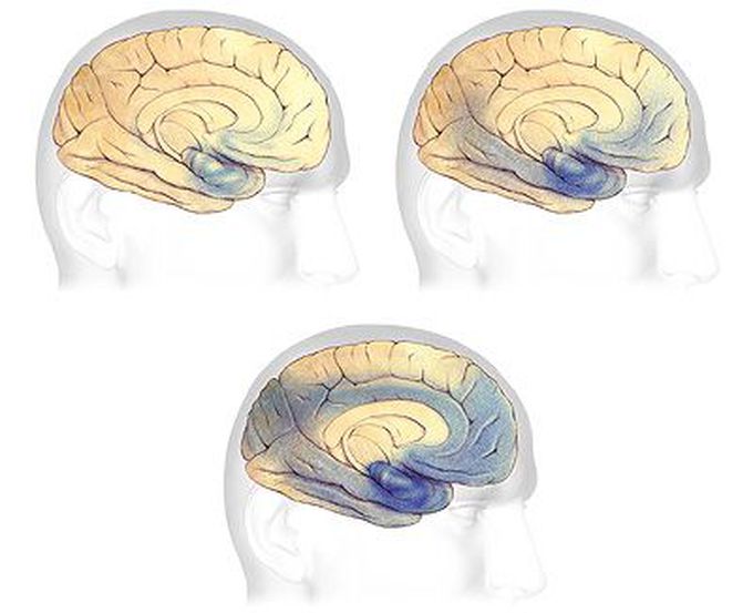 Alzheimer disease