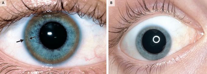 Wilson Disease and Kayser Fleischer Ring