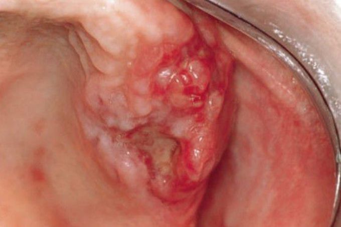 Tuberculosis of maxillary alveolar ridge