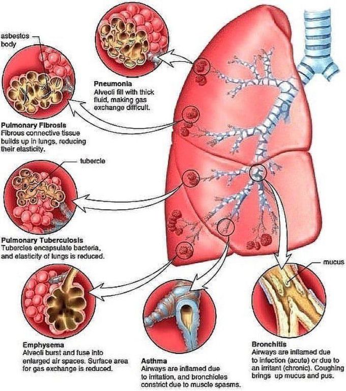 A quick review of lung diseases