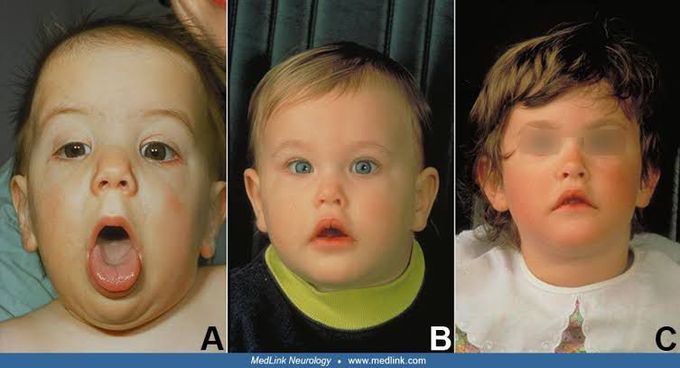 joubert syndrome