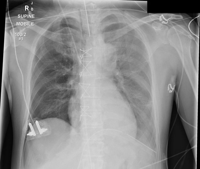 Post CABG chest x -ray