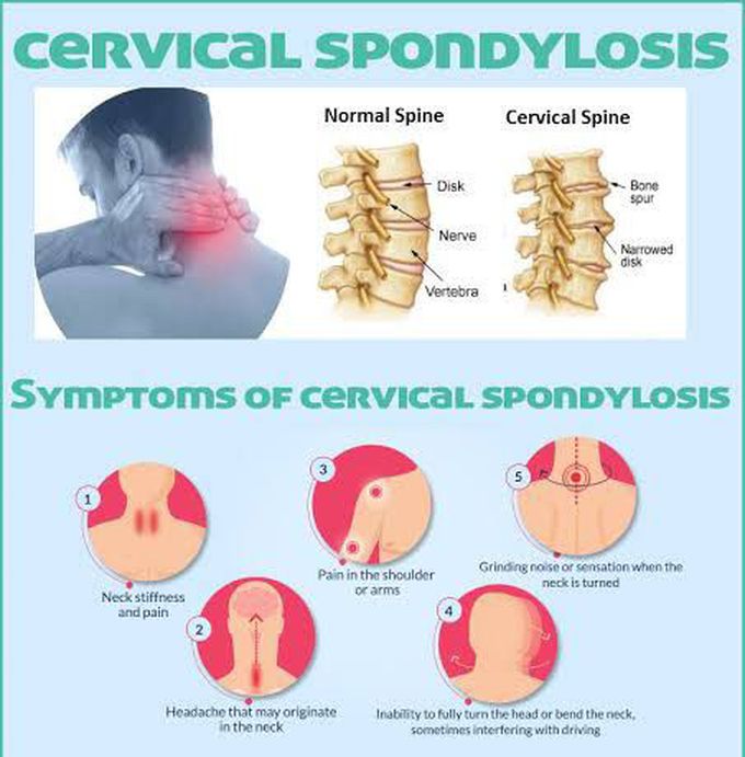 These are the symptoms of Cervical syndrome
