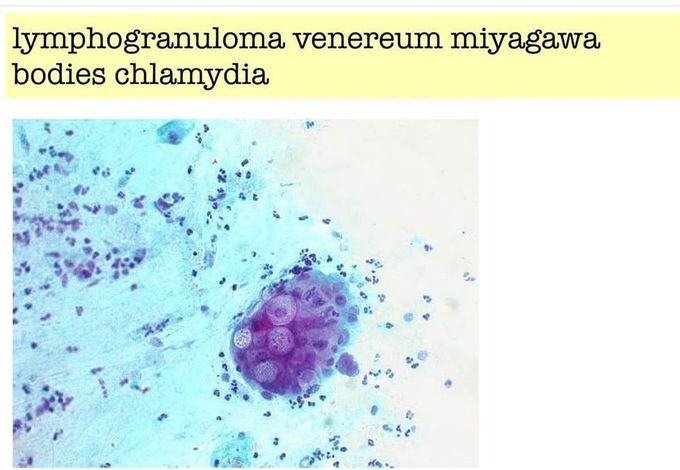 Lymphogranuloma Bodies