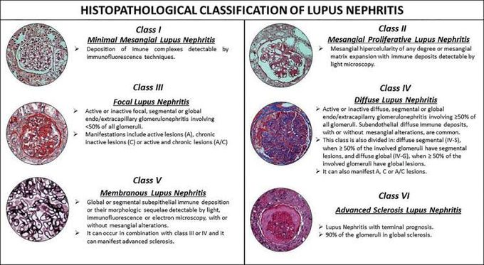 Classification of Lupus Nephritis