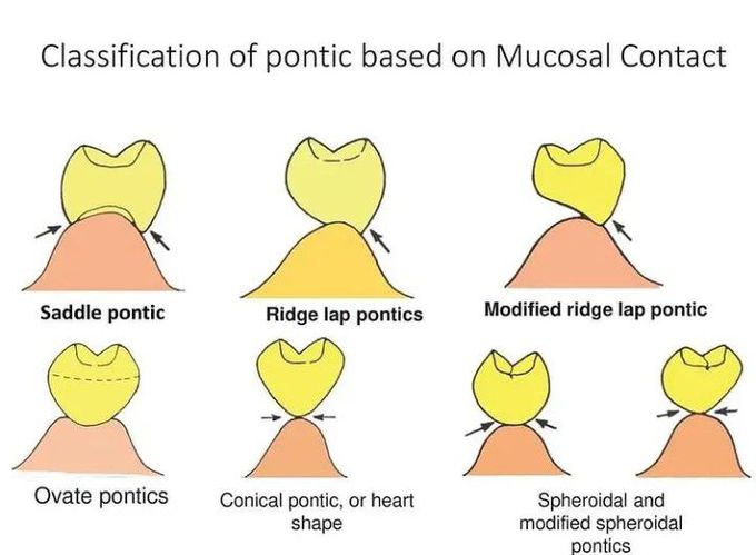 Classification of Pontics