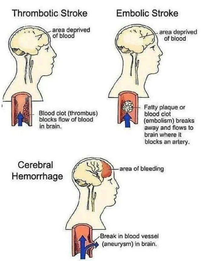Types of Stroke