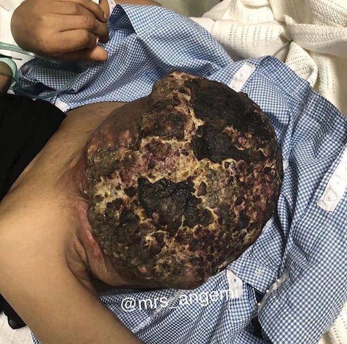 4th stage of breast cancer ♋️