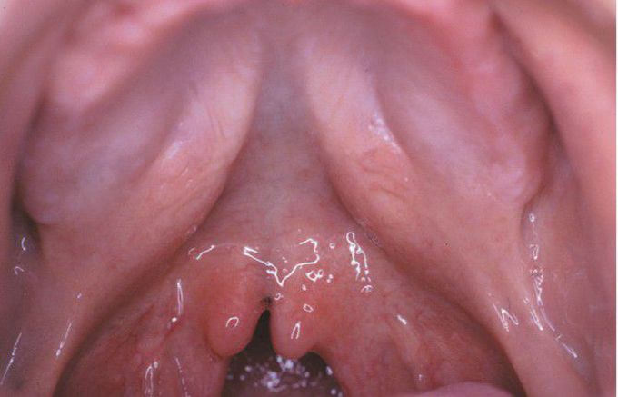 Submucosal cleft palate