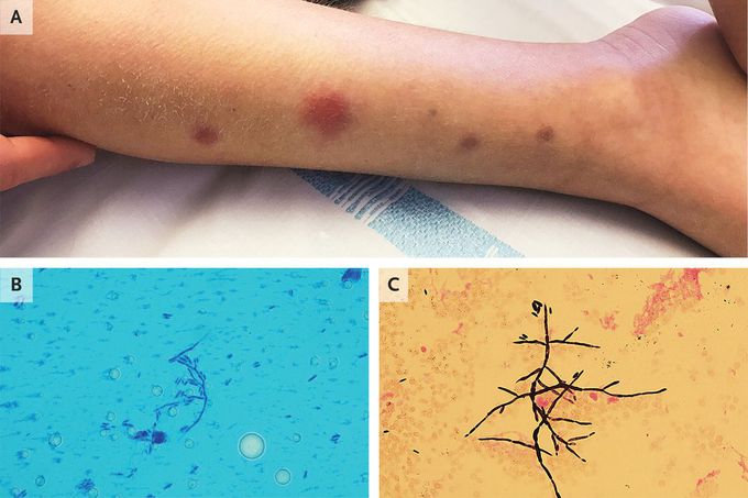Disseminated Fusariosis