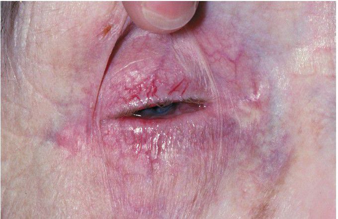 Mucous Membrane Pemphigoid (Blindness)