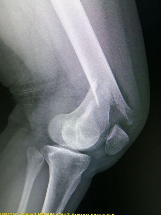 Distal femoral fractures