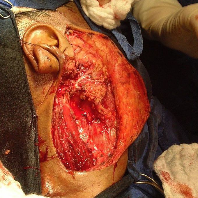 Warthin tumor
