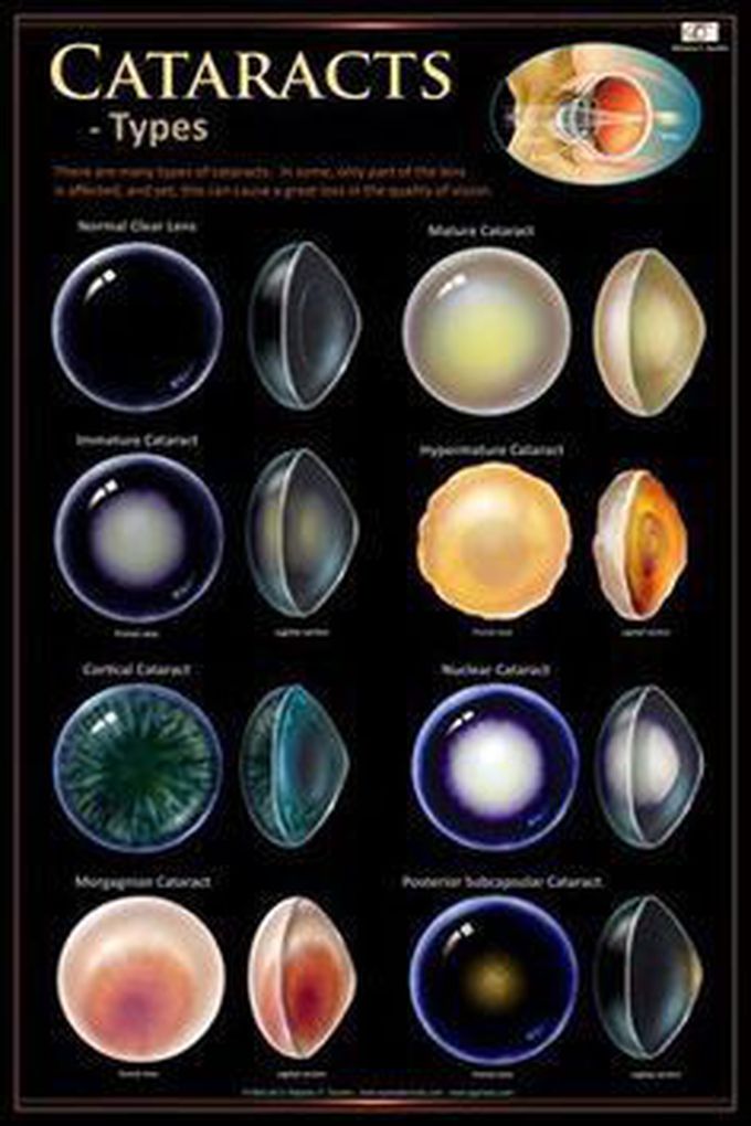 Cataract types