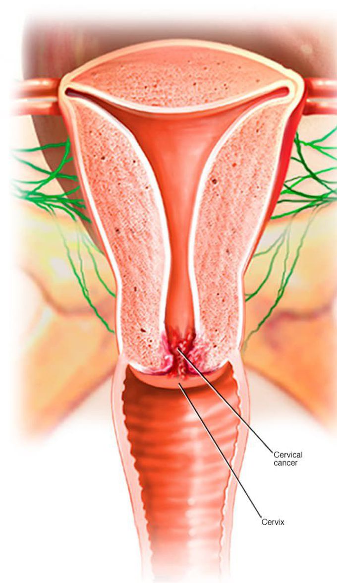 Cervical cancer