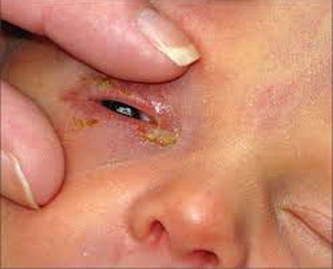 Ophthalmia neonatorum