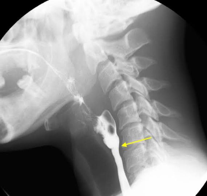 Plummer-Vinson syndrome