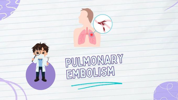 Pulmonary embolism: Pathophysiology, Types, diagnosis, & Treatment