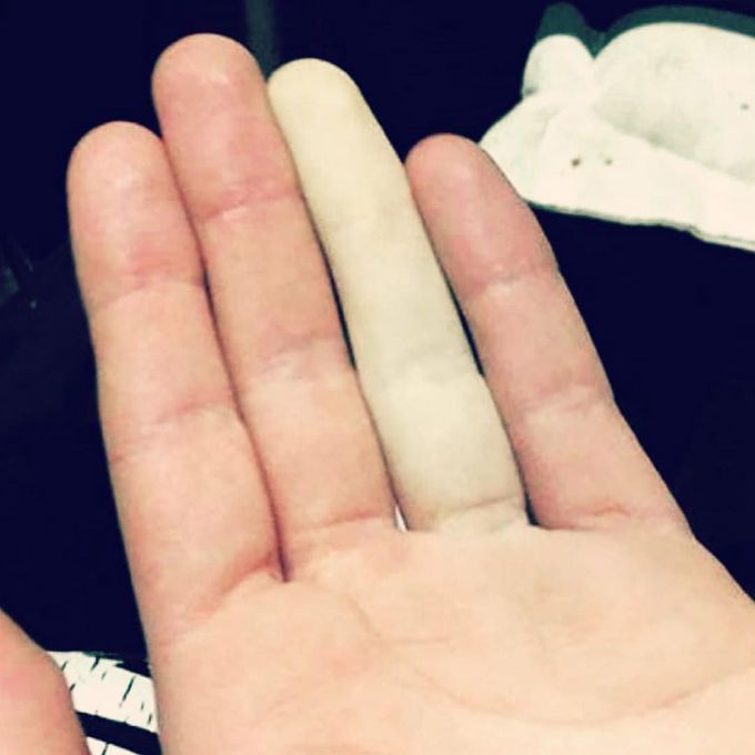  Raynaud’s phenomenon