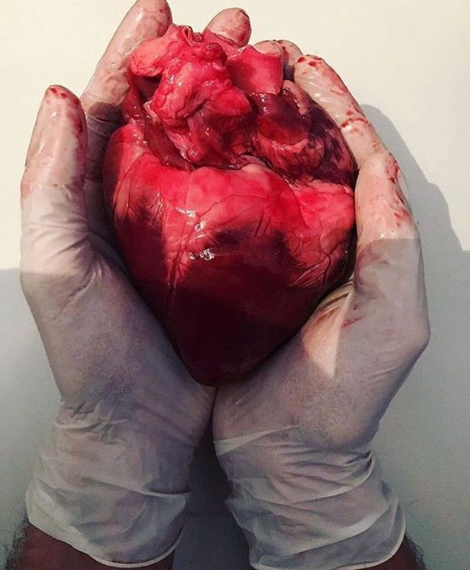 heart surgery