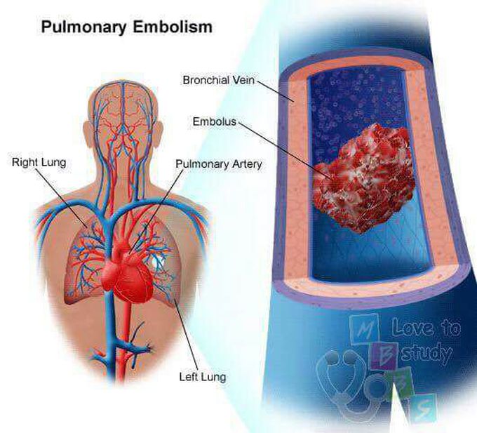 Pulmonary embolism process