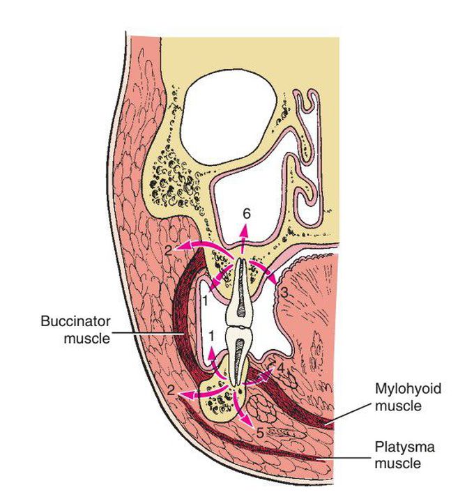 Pathway of odontogenic infection