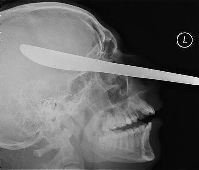 The X-ray of a miracle stab victim who had a BUTTER KNIFE embedded in his skull through the side of his nose