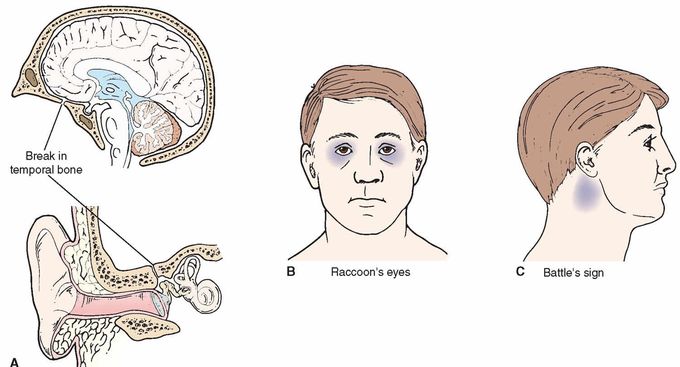 2 clinical manifestation related to skull base fx