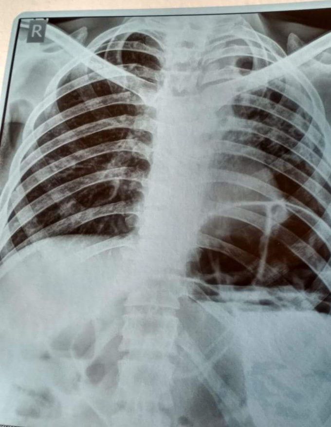 past history of pulmonary Tb