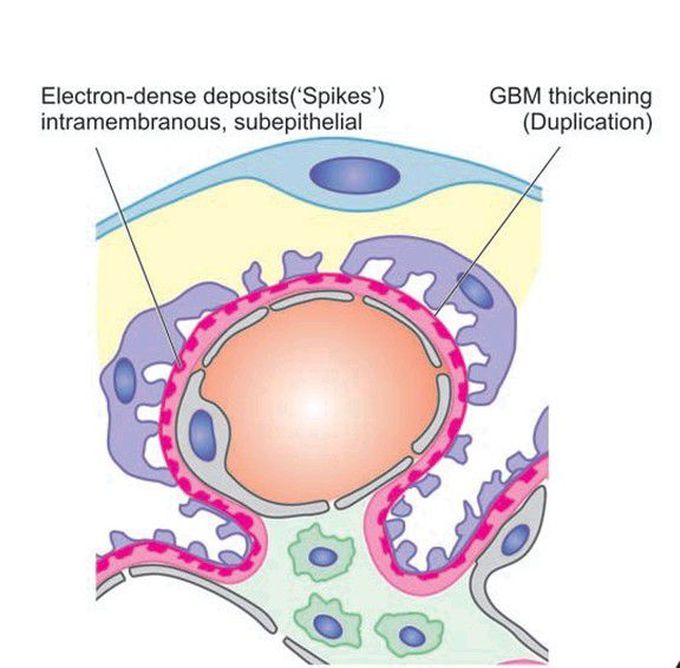 Membranous Glomerulonephritis