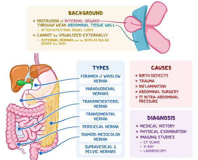 Internal Hernia