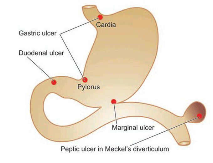 Peptic ulcers