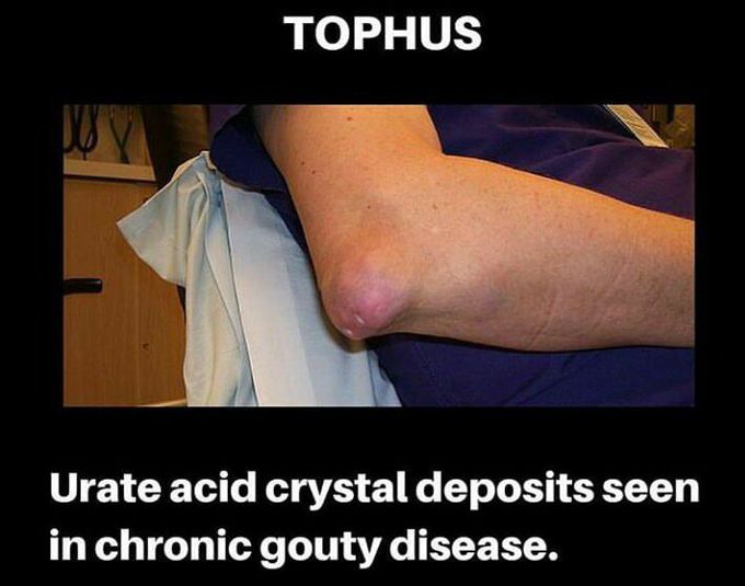 Tophus