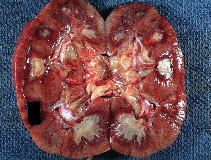 Renal papillary necrosis