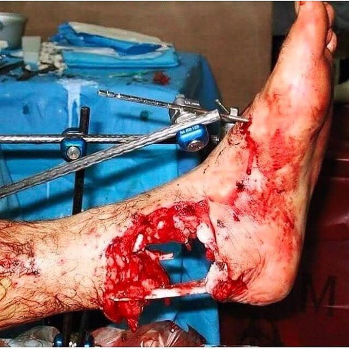 Shotgun Foot Injury