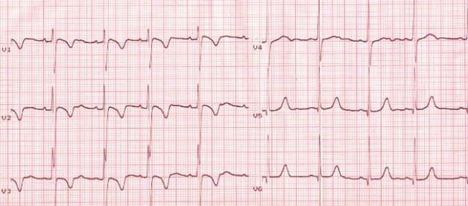 What May Cause Inverted T-waves on ECG?