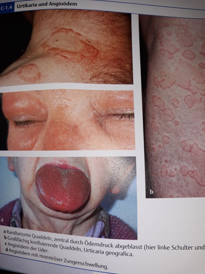 Urticaria & Angioedema