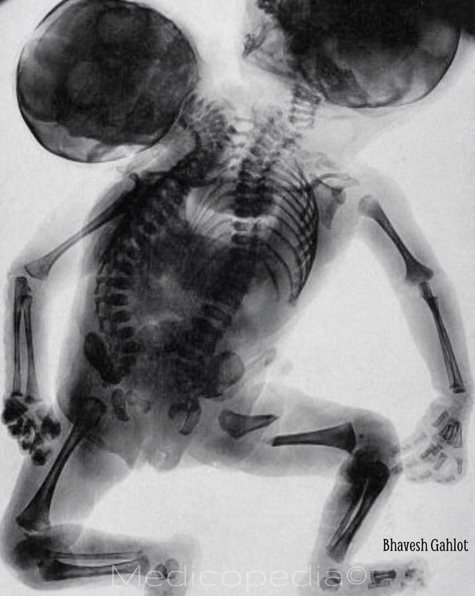 X-ray of conjoined twins