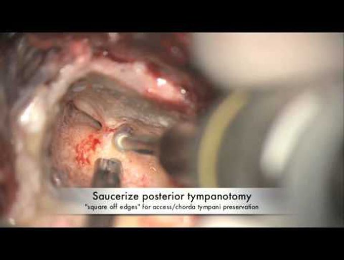 Cochlear implant placement: round window approach