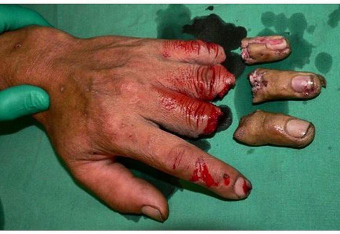 Found the missing fingers!